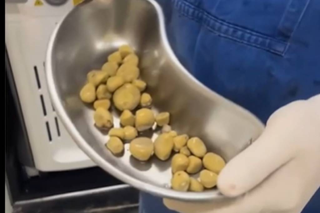 Homem tem 35 pedras retiradas de bexiga em cirurgia em MG - 12/05/2025 - Equilíbrio e Saúde