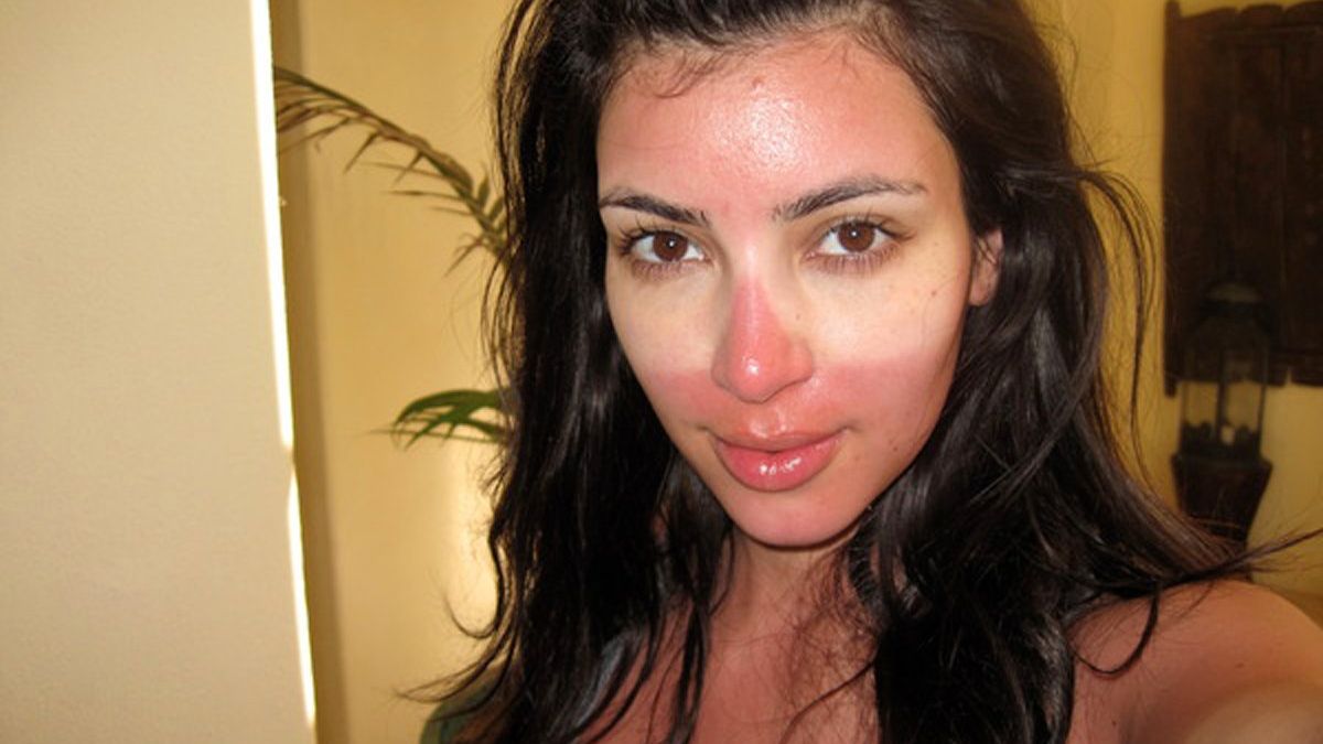 Como se livrar da queimadura solar rapidamente, de acordo com os dermatologistas