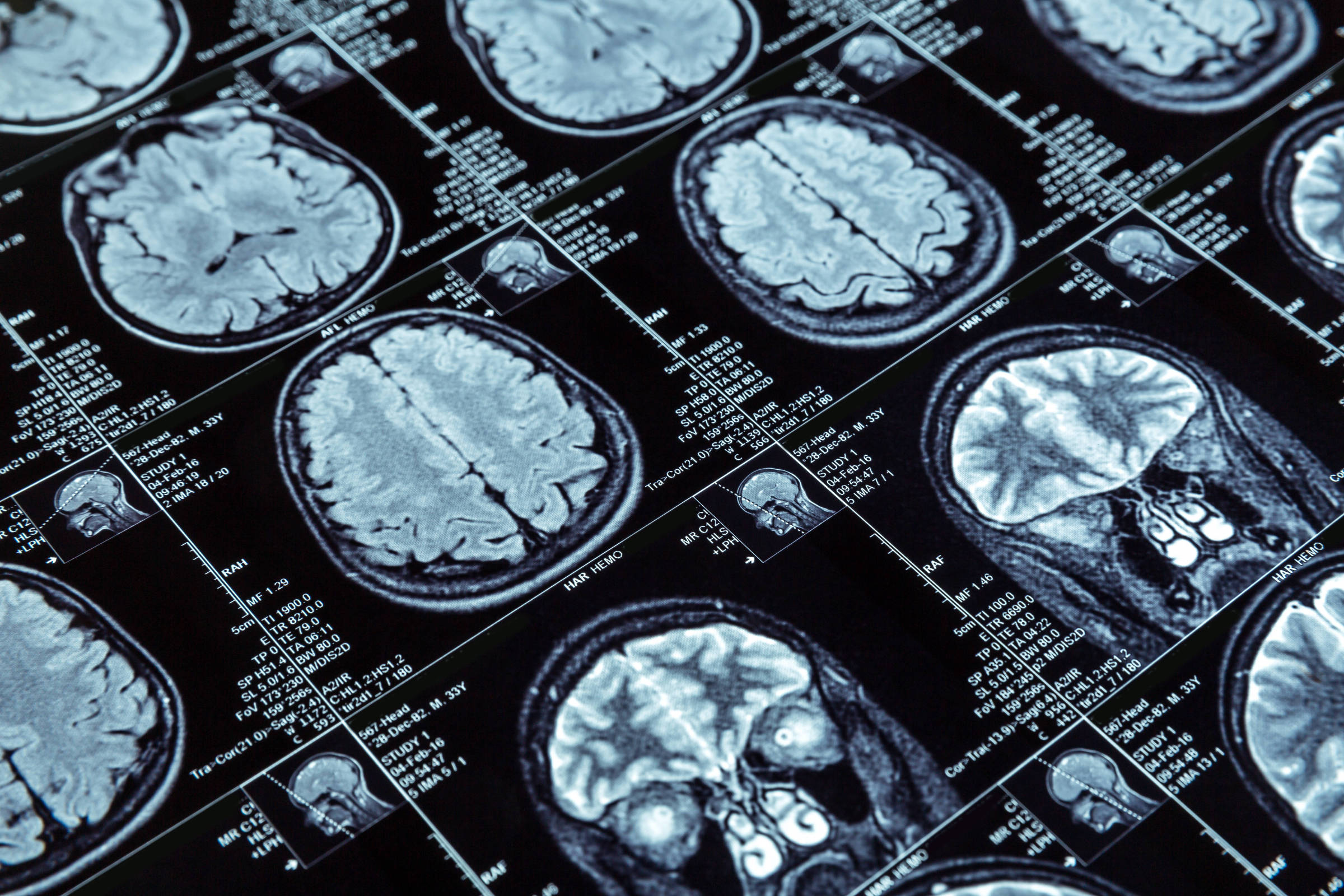 Cinco descobertas promissoras no combate ao Alzheimer 2025 - 28/09/2025 - Equilíbrio e Saúde