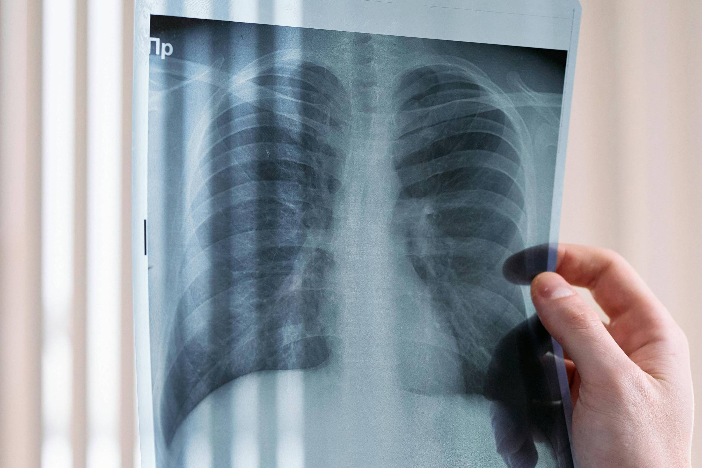 Vacina contra o câncer de pulmão entrará em fase de testes - 25/11/2025 - Equilíbrio e Saúde