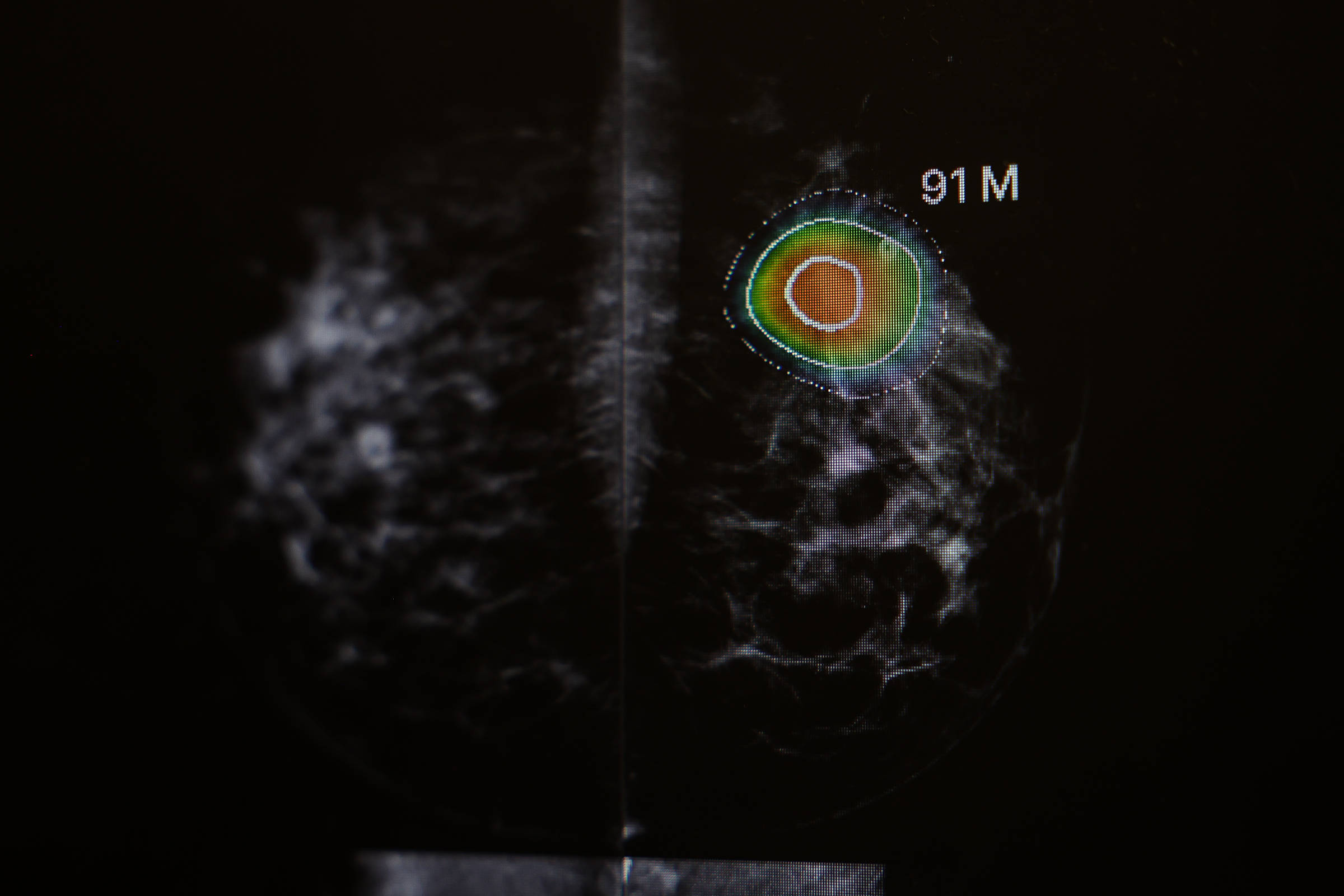 Mamografia com IA melhora diagnóstico de câncer - 29/01/2026 - Equilíbrio e Saúde
